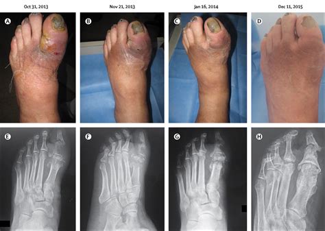 Osteomyelitis left great toe icd 10 - ANSWERS E11.621 Type 2 diabetes mellitus with foot ulcer L97.522 Non-pressure chronic ulcer of other part of left foot with fat layer exposed E11.65 Type 2 diabetes mellitus with hyperglycemia Z79.4 Long term (current) use of insulin E11.69 Type 2 diabetes mellitus with other specified complication